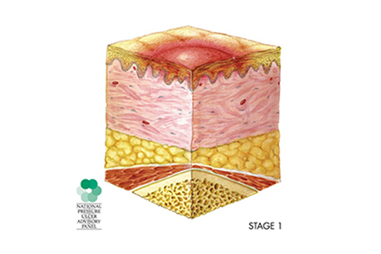 Recognizing and Treating Illustrated graphic of a pressure sore